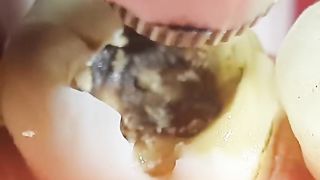 Caries GIGANTE con HONGOS?? en 4k - Tratamiento de conducto