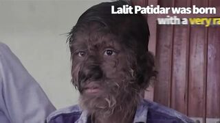 Boy Born with Extremely Rare 'Werewolf Syndrome