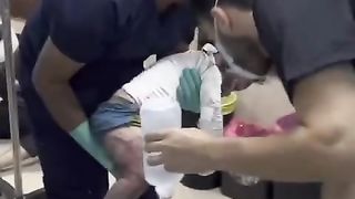 A little girl suffered burns all over her body