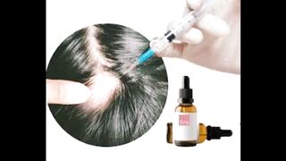 علاج الثعلبة بالأعشاب وصفات طبيعية لتحفيز نمو الشعر وتقوية فروة الرأس