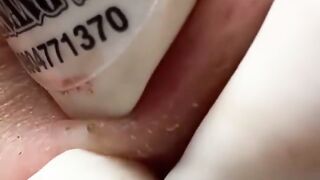 Squeeze pimples