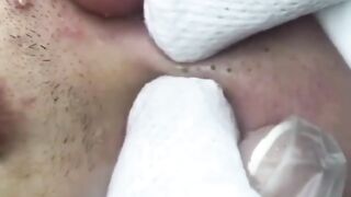 Squeeze pimples 2