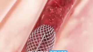 How to Clean Blood Vessel