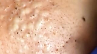 #spa #relax #asmr #acne #pimple #squeeze