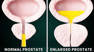 The Best Treatment for Enlarged Prostate: Prostate Artery Embolization