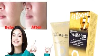 Tri Melas Cream Price In Pakistan - 03265721280