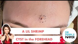 A Lil Shrimp Cyst in the Forehead